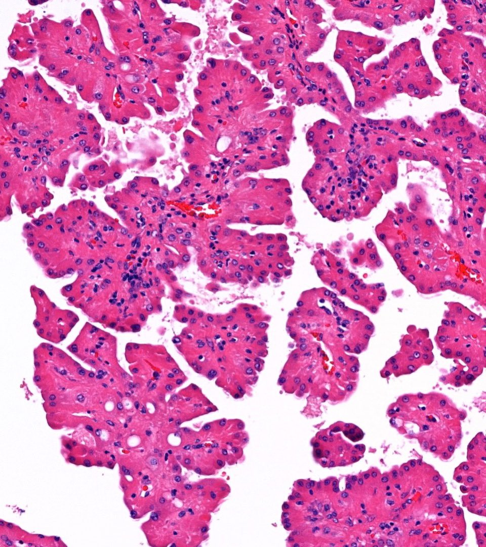 RobHumbleMD's tweet image. Incidental finding on nephrectomy for ccRCC. What do you think? #GUpath 🔬