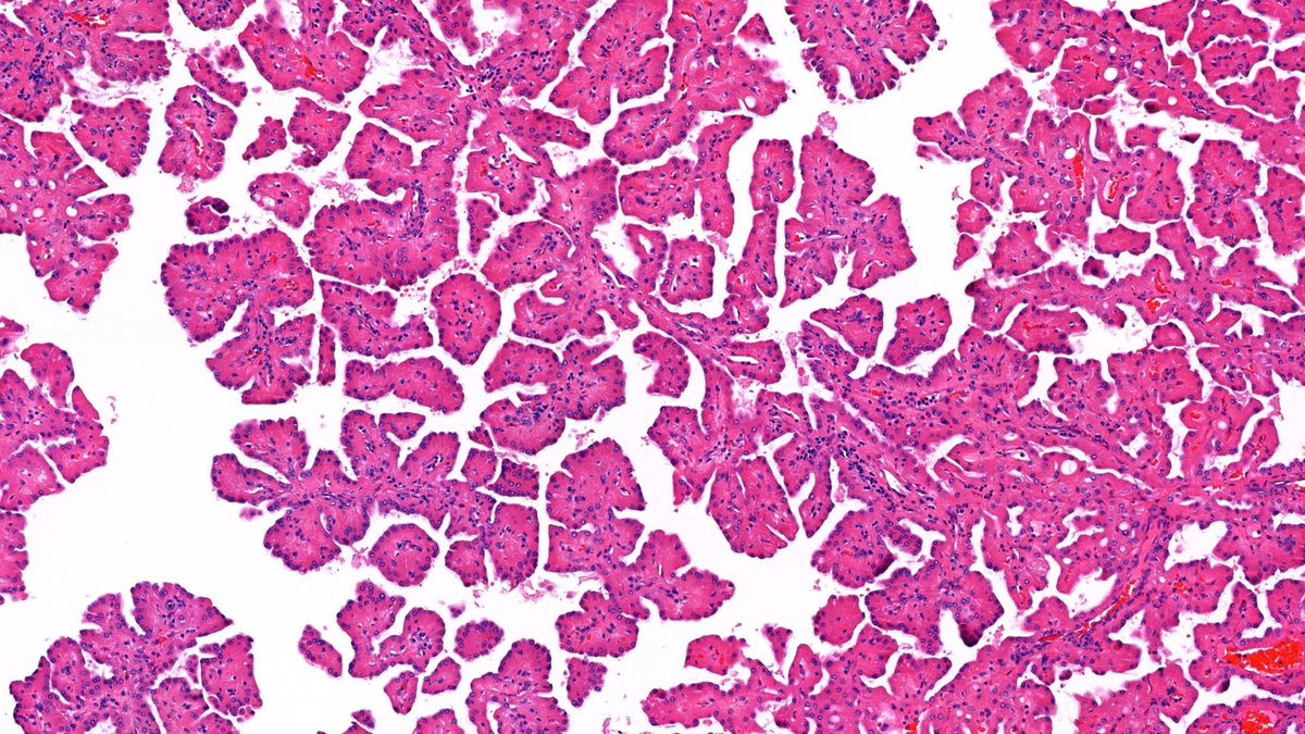 RobHumbleMD's tweet image. Incidental finding on nephrectomy for ccRCC. What do you think? #GUpath 🔬