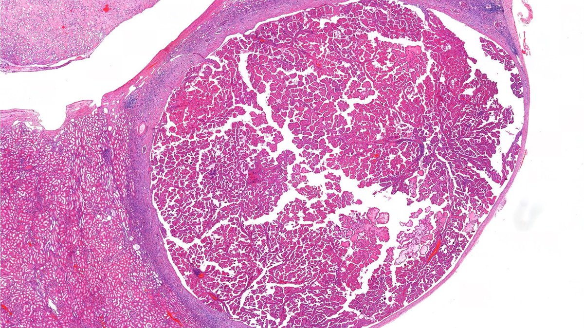 RobHumbleMD's tweet image. Incidental finding on nephrectomy for ccRCC. What do you think? #GUpath 🔬