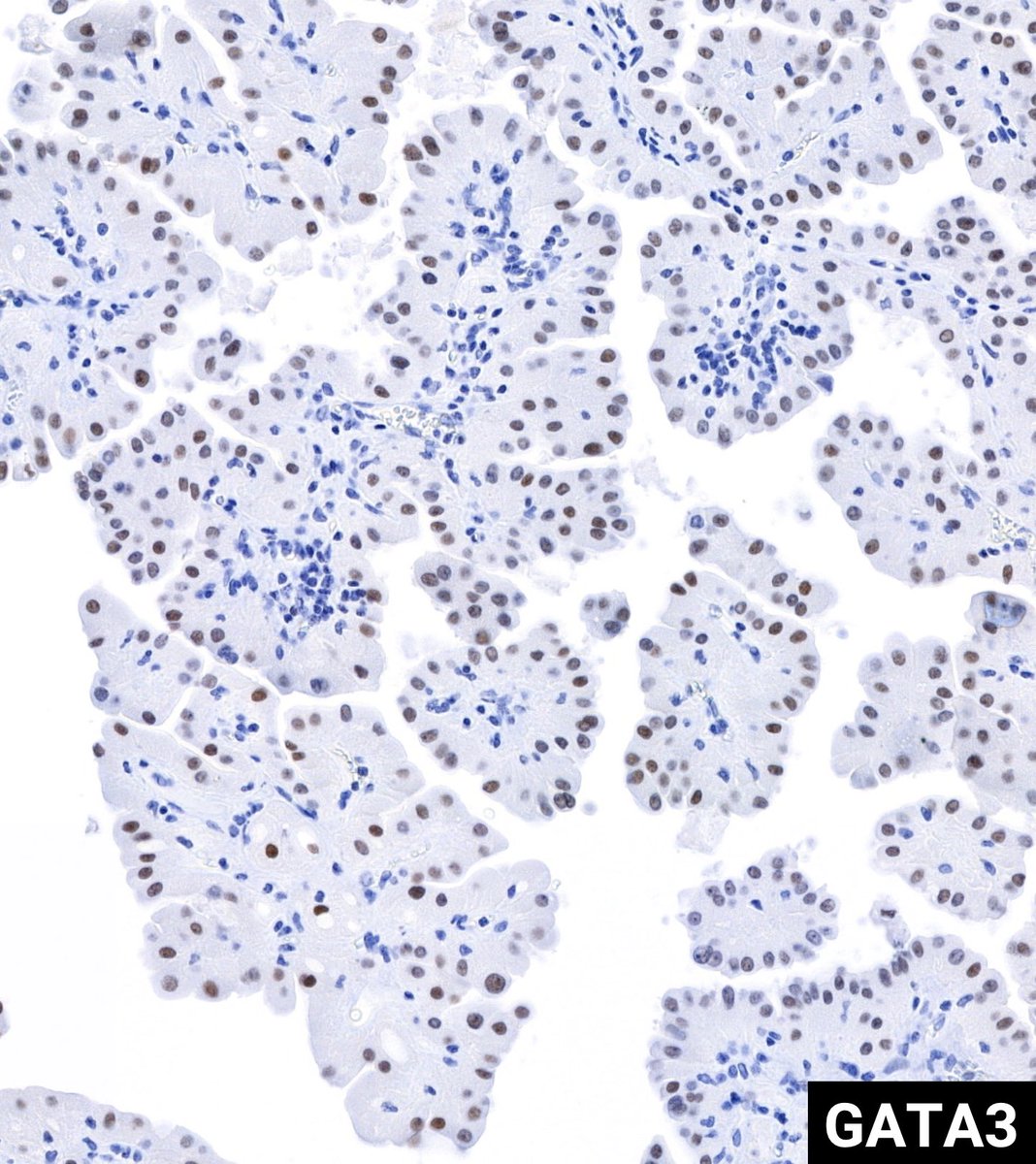 RobHumbleMD's tweet image. Incidental finding on nephrectomy for ccRCC. What do you think? #GUpath 🔬