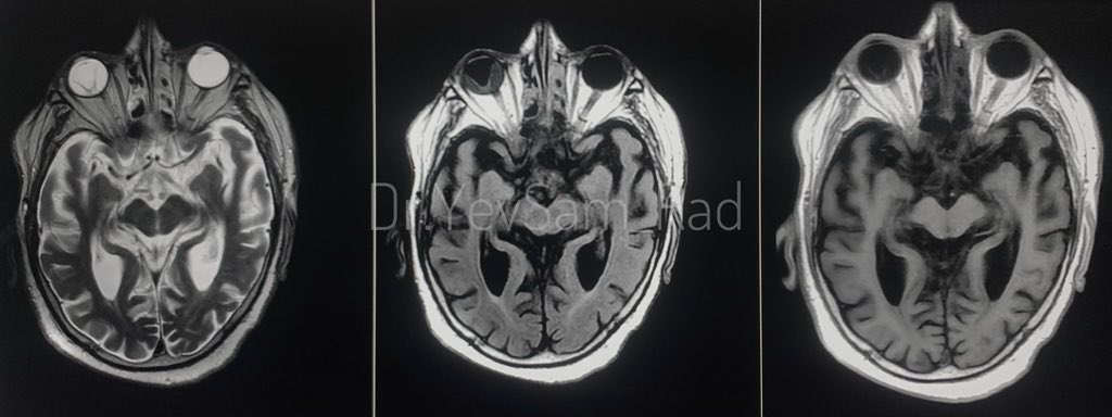 DrYevSam_Rad's tweet photo. The 👁️ for the 👁️ ! Look outside the box.
#spottertime
#neuroimaging
#MedTwitter
#FOAMed
#FOAMRad
@drvenkimdrd https://t.co/02o4n04nPq