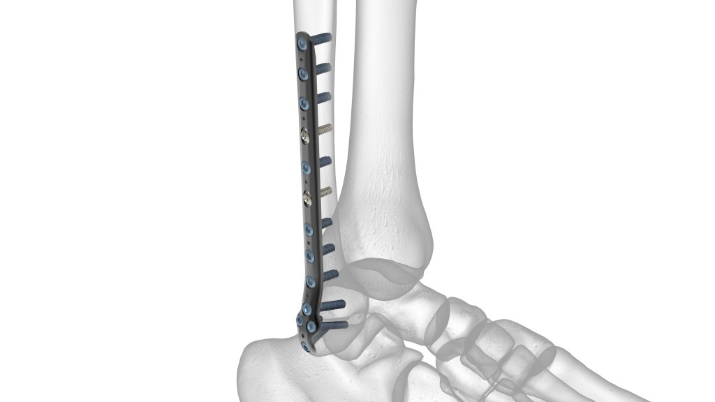 siorasurgicals's tweet image. The metaphyseal end of such a plate enables the insertion of a cluster of LHS in a convergent or divergent manner to improve their pull strength.
siiora.com/blogs/overview…
#bone #screws #siora #surgicals #plates #instruments #orthopedic #implants #LCPdistalfemur #medical #health