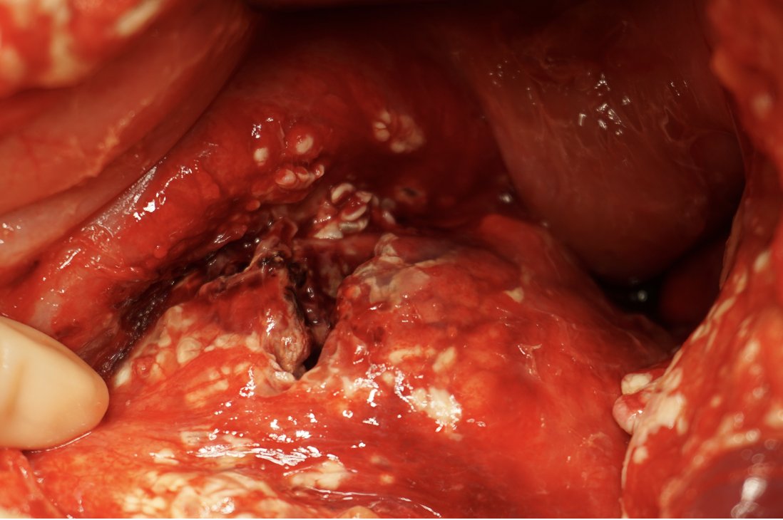Dr. Dennis Yong Kim, MMEd (@traumaicurounds) on Twitter photo Blunt pancreatic #injury
🔹Morbidity (up to 60%) & mortality (10-30%)
🔸High index of suspicion KEY ▶️ CT!
🔹<5/year even @ high volume center
🔸Serial lipase & MRI NOT as helpful as you think!!
Many gaps & unanswered questions...
<a href="/WesternTrauma/">WesternTrauma</a> <a href="/RaulCoimbraMD/">Raul Coimbra, MD, PhD</a> <a href="/docmartin22/">Matthew Martin, MD, FACS, McRIB</a> Blunt pancreatic #injury
🔹Morbidity (up to 60%) & mortality (10-30%)
🔸High index of suspicion KEY ▶️ CT!
🔹<5/year even @ high volume center
🔸Serial lipase & MRI NOT as helpful as you think!!
Many gaps & unanswered questions...
<a href="/WesternTrauma/">WesternTrauma</a> <a href="/RaulCoimbraMD/">Raul Coimbra, MD, PhD</a> <a href="/docmartin22/">Matthew Martin, MD, FACS, McRIB</a>