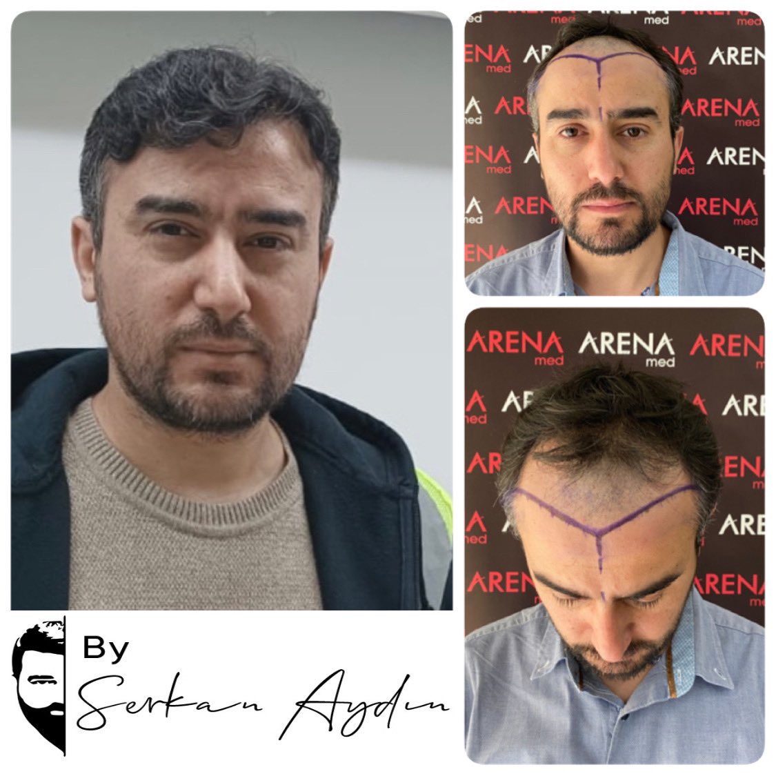 Arenamedd's tweet photo. #serkanaydin #arenamed #saçlıseferleri #hayallerdökülmez #srk #hayallerdökülmezsrk #hayallerdökülmezserkanaydın
#saçaatılanimzaserkanaydın #thesignatureonhairserkanaydın #saçaatılanimza #thesignatureonhair #srkline 🧿👍 https://t.co/VU5ln1dq3i