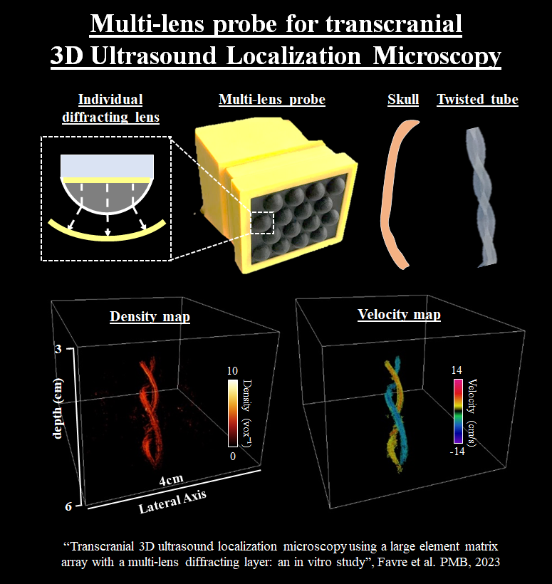 Clement Papadacci (@cpapadacci) on Twitter photo Please find the in vitro validation of the multi-lens concept for transcranial 3D ULM! Co-authored by FavreH PernotM and <a href="/TanterM/">Tanter Mickael</a> from <a href="/PhysMedParis/">Physics for Medicine Paris</a>.
Sponsors are <a href="/ERC_Research/">European Research Council (ERC)</a> <a href="/NVIDIAAIDev/">NVIDIA AI Developer</a> and institutions <a href="/Inserm/">Inserm</a> <a href="/ESPCI_Paris/">ESPCI Paris - PSL</a> <a href="/psl_univ/">Université PSL</a>.
Enjoy!!
doi.org/10.1088/1361-6… Please find the in vitro validation of the multi-lens concept for transcranial 3D ULM! Co-authored by FavreH PernotM and <a href="/TanterM/">Tanter Mickael</a> from <a href="/PhysMedParis/">Physics for Medicine Paris</a>.
Sponsors are <a href="/ERC_Research/">European Research Council (ERC)</a> <a href="/NVIDIAAIDev/">NVIDIA AI Developer</a> and institutions <a href="/Inserm/">Inserm</a> <a href="/ESPCI_Paris/">ESPCI Paris - PSL</a> <a href="/psl_univ/">Université PSL</a>.
Enjoy!!
doi.org/10.1088/1361-6…