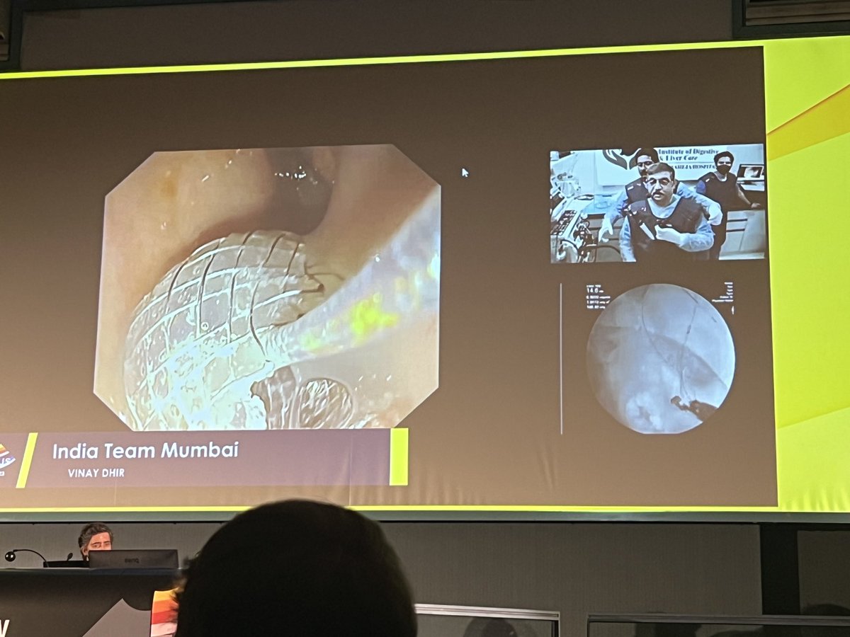 Cholecystoduodenostomy performed by Vinay Dhir from Mumbai during #euroeus2023