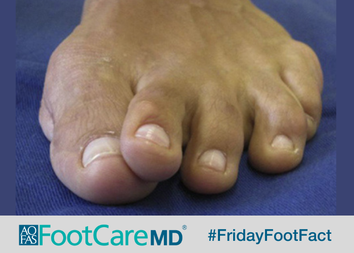 The plantar plate is a ligament in the ball of your foot. If it tears, your second toe may move towards your big toe and even overlap. See how foot &amp; ankle orthopaedic surgeons treat plantar plate tears at #FootCareMD: ow.ly/OtCY50N0YSo #FridayFootFact