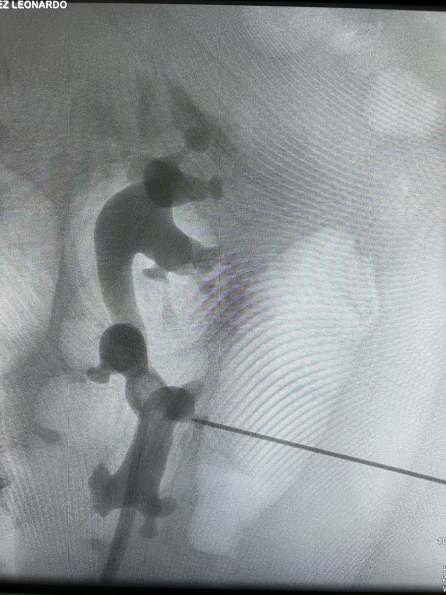 UroDrLopez's tweet photo. Sharing impressions about #SMP #miniPNL in Valladolid with @drmarcoscepeda @CoralManso Hospital Río Hortega Downsizing + active irrigation&amp;aspiration for anomalous anatomy @DornierMedTech @zeng_guohua https://t.co/z7JApvn08S