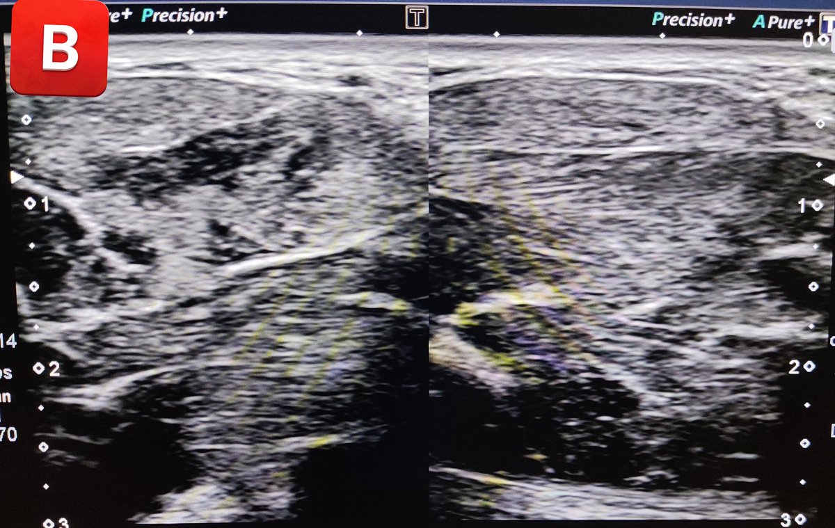 LuisaNieMor's tweet photo. Imagen A: Lost of fibrillar pattern in the dorsal interossei muscle on the right hand. 
Image B: comparison with the other side.
These findings are suggestive of DOMS. The pain began inmediately after a workout. https://t.co/bkYxvRGKka