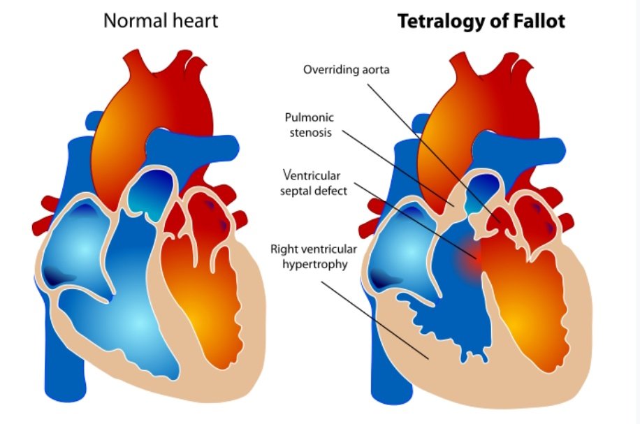 New wee blog from me, on living with Atrial Fibrillation & the term Heart Failure iamthedj40.blogspot.com/2023/03/living…