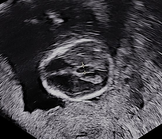 dragibert's tweet image. Contra los #defectoscongenitos: prevención (ácido fólico, vacunas, protegerse contra las infecciones) y un buen #controlprenatal.  ¿Voluntarixs para diagnosticar este feto? #diamundialdelosdefectoscongenitos 2023 #diagnosticoprenatal