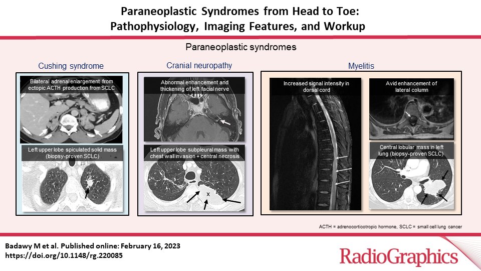 RadioGraphics_Editor (@radg_editor) on Twitter photo Paraneoplastic Syndromes from Head to Toe: Pathophysiology, Imaging Features, and Workup
Badawy M et al
Multisystem Radiology
doi.org/10.1148/rg.220…
<a href="/MBadawy_MD/">Mohamed Badawy</a>
<a href="/MargaritaRevzin/">Dr. Margarita Revzin</a>
@Nikitaconsul
<a href="/Moa_soliman_MD/">MOATAZ SOLIMAN</a>
@Elsayeskhaled
@MDandersonnews
@yaleradiolog
#RGphx
6/12 Paraneoplastic Syndromes from Head to Toe: Pathophysiology, Imaging Features, and Workup
Badawy M et al
Multisystem Radiology
doi.org/10.1148/rg.220…
<a href="/MBadawy_MD/">Mohamed Badawy</a>
<a href="/MargaritaRevzin/">Dr. Margarita Revzin</a>
@Nikitaconsul
<a href="/Moa_soliman_MD/">MOATAZ SOLIMAN</a>
@Elsayeskhaled
@MDandersonnews
@yaleradiolog
#RGphx
6/12