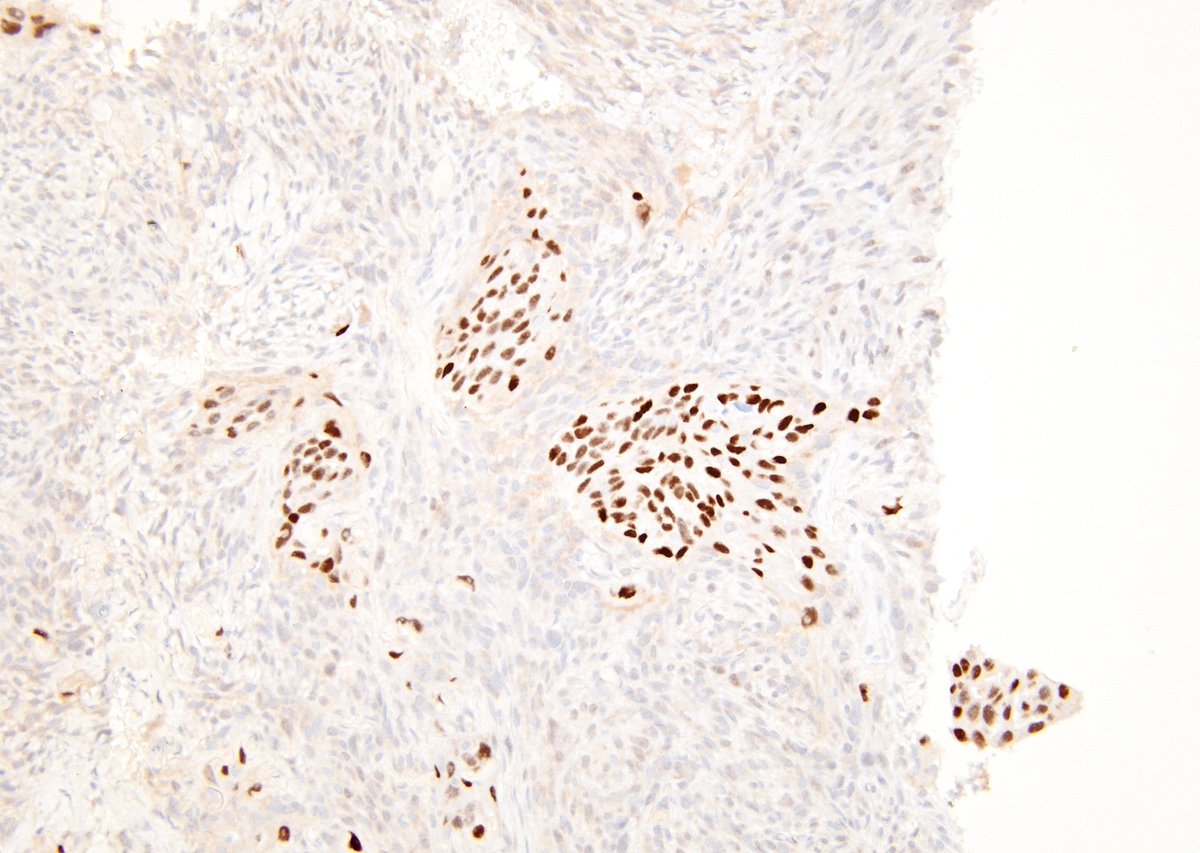 IMPRESSIVE case illustrating transformation of a Papillary Thyroid Carcinoma, Tall Cell Subtype (patient is S/P total thyroidectomy) to an Anaplastic Thyroid Carcinoma 9 years later (FNA of a Level 3 neck node). (Core bx and PAX8, focally positive in more epithelioid areas).