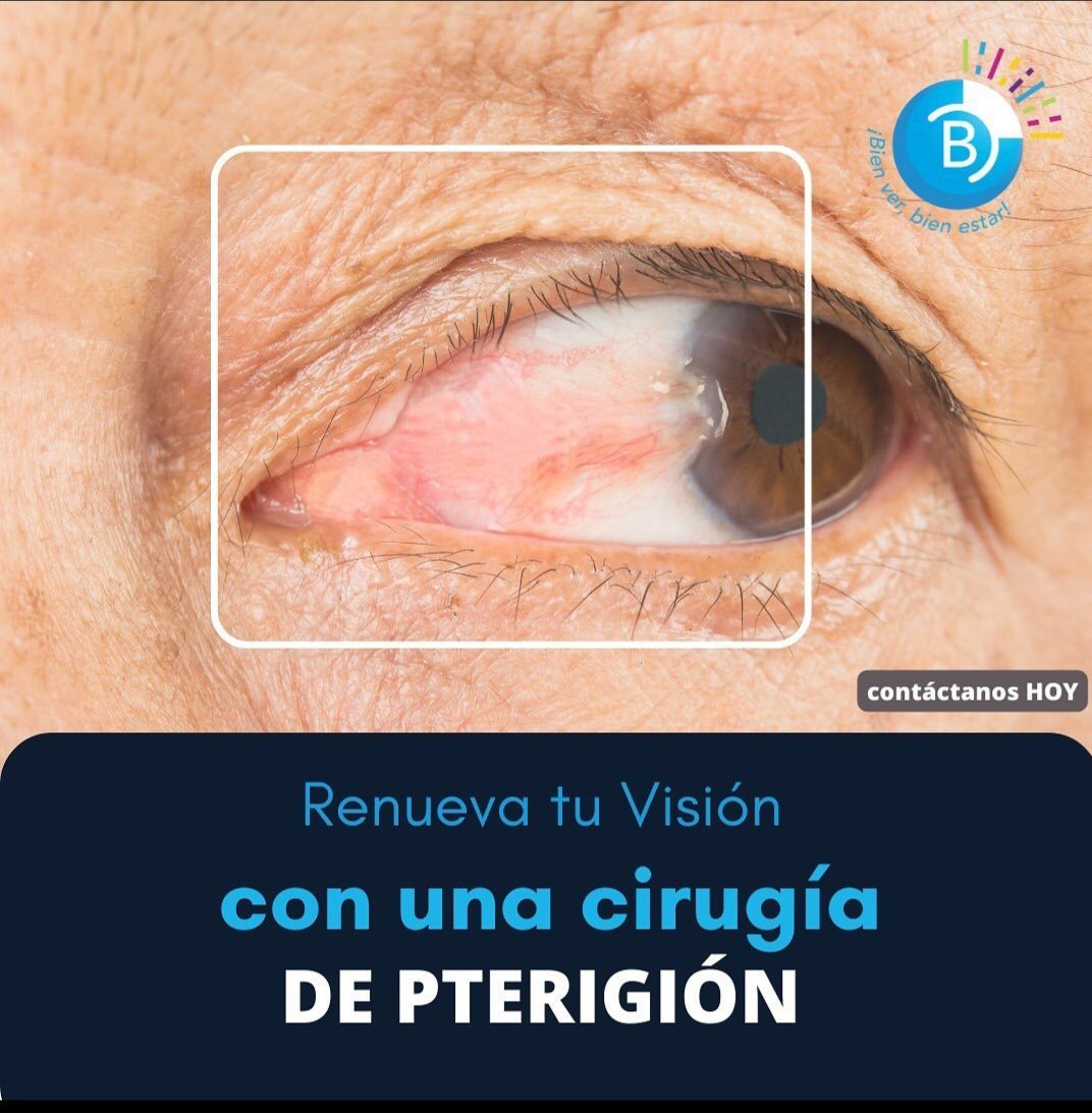 Que es pterigión es un crecimiento de tejido carnoso (compuesto de vasos sanguíneos) que puede comenzar como una pingüécula. Puede permanecer pequeño o crecer a un tamaño suficientemente grande como para cubrir parte de la córnea. Cuando esto sucede, puede afectarle la visión.