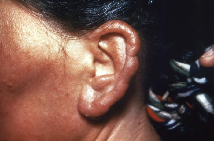 Hoy es viernes de...#SEMTSICHALLENGE

❓Que enfermedad sospecharias
1⃣Lepra
2⃣ Sifilis
3⃣ Leishmaniasis

La respuesta mas tarde en nuestra cuenta...🕕
Imagen: CDC/ Arthur E. Kayne