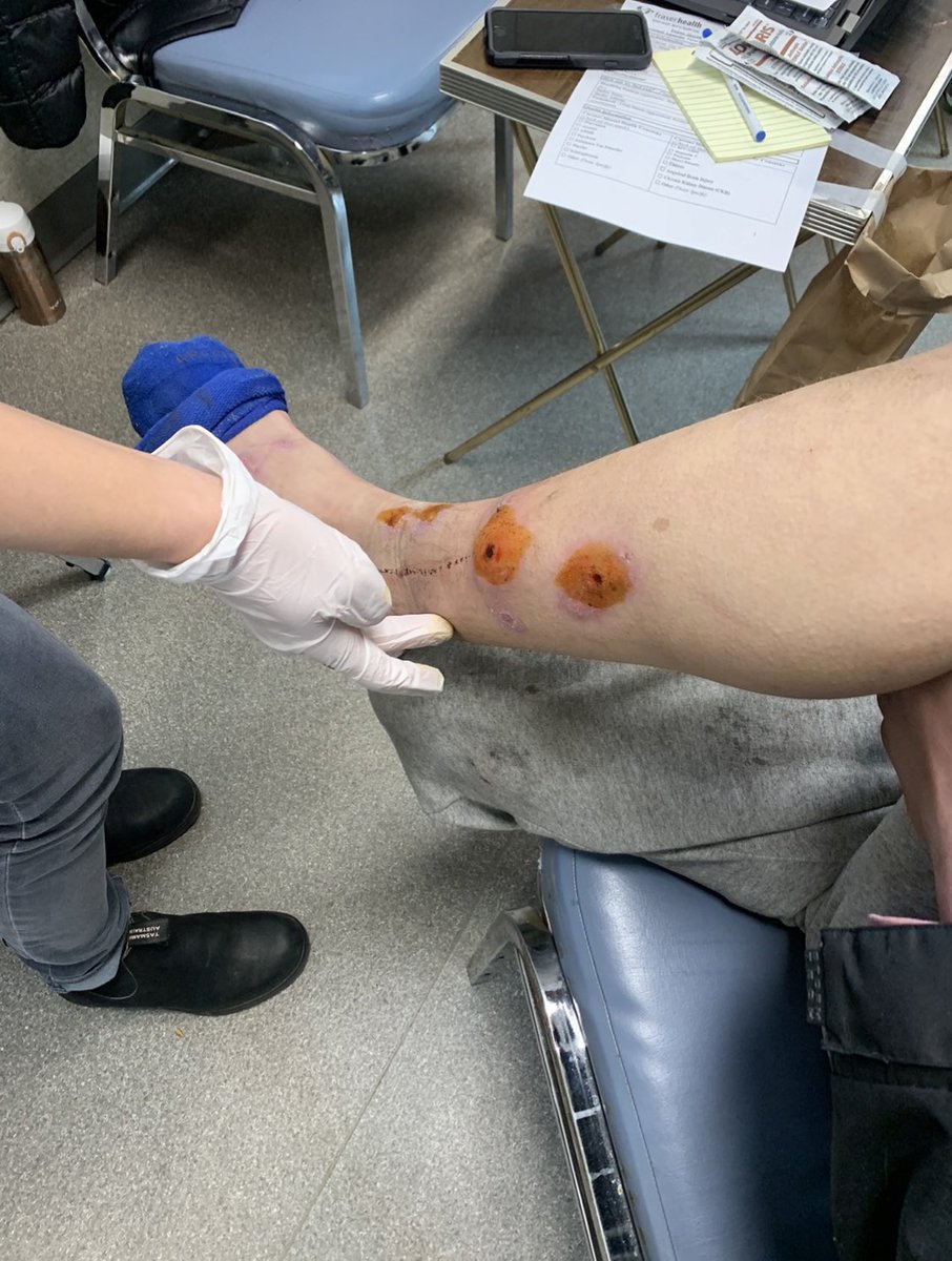 Biting cold, lack of health care, inequitable access to hygiene & nutrition, accidents and diseases can lead to chronic wounds for many. We are grateful for the healing brought to the most vulnerable at our shelter by an exceptional team of @Fraserhealth nurses. #PublicHealth