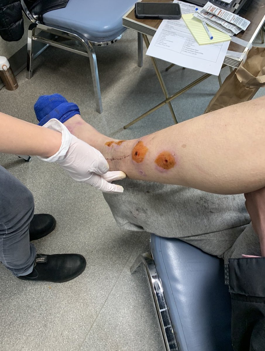 Engaged Communities (ECCS) (@engagedcommuni2) on Twitter photo Biting cold, lack of health care, inequitable access to hygiene & nutrition, accidents and diseases can lead to chronic wounds for many. We are grateful for the healing brought to the most vulnerable at our shelter by an exceptional team of <a href="/Fraserhealth/">Fraser Health</a> nurses.
#PublicHealth Biting cold, lack of health care, inequitable access to hygiene & nutrition, accidents and diseases can lead to chronic wounds for many. We are grateful for the healing brought to the most vulnerable at our shelter by an exceptional team of <a href="/Fraserhealth/">Fraser Health</a> nurses.
#PublicHealth