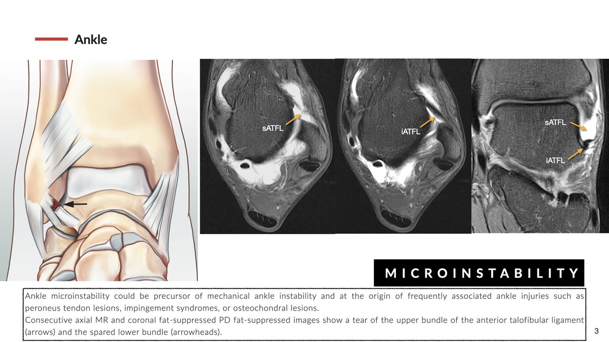 Ankle Microinstability might be the precursor for classic mechanical instability. It is secondary to the lesion of the superior fascicle of the anterior talofibular ligament. MRI and MR-arthrography, are key in precisely diagnosing ligament lesions and associated injuries