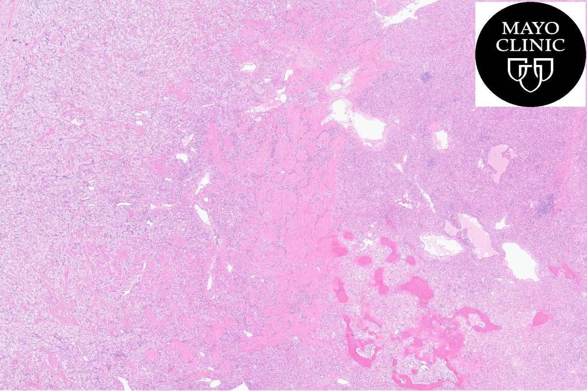 MayoPathology's tweet image. 💢Renal mass💢 Your Dx❓💡🔬#Trainee #pathology #PathTwitter @RenalGUPath #GUpath