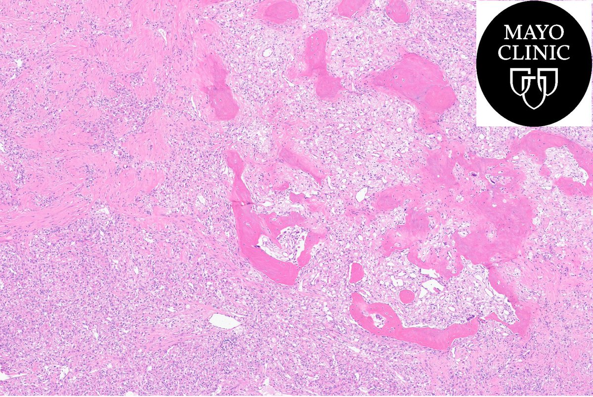MayoPathology's tweet image. 💢Renal mass💢 Your Dx❓💡🔬#Trainee #pathology #PathTwitter @RenalGUPath #GUpath