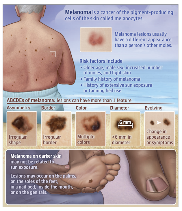 Why does every person with Parkinson's need to put on high SPF sunscreen? Recent meta-analysis showed 3.6X risk of melanoma. NOT related to Parkinson medications. Check out this patient page in <a href="/JAMA_current/">JAMA</a> Patient Information: Melanoma ja.ma/3ZwgFxy   <a href="/JAMANeuro/">JAMA Neurology</a>