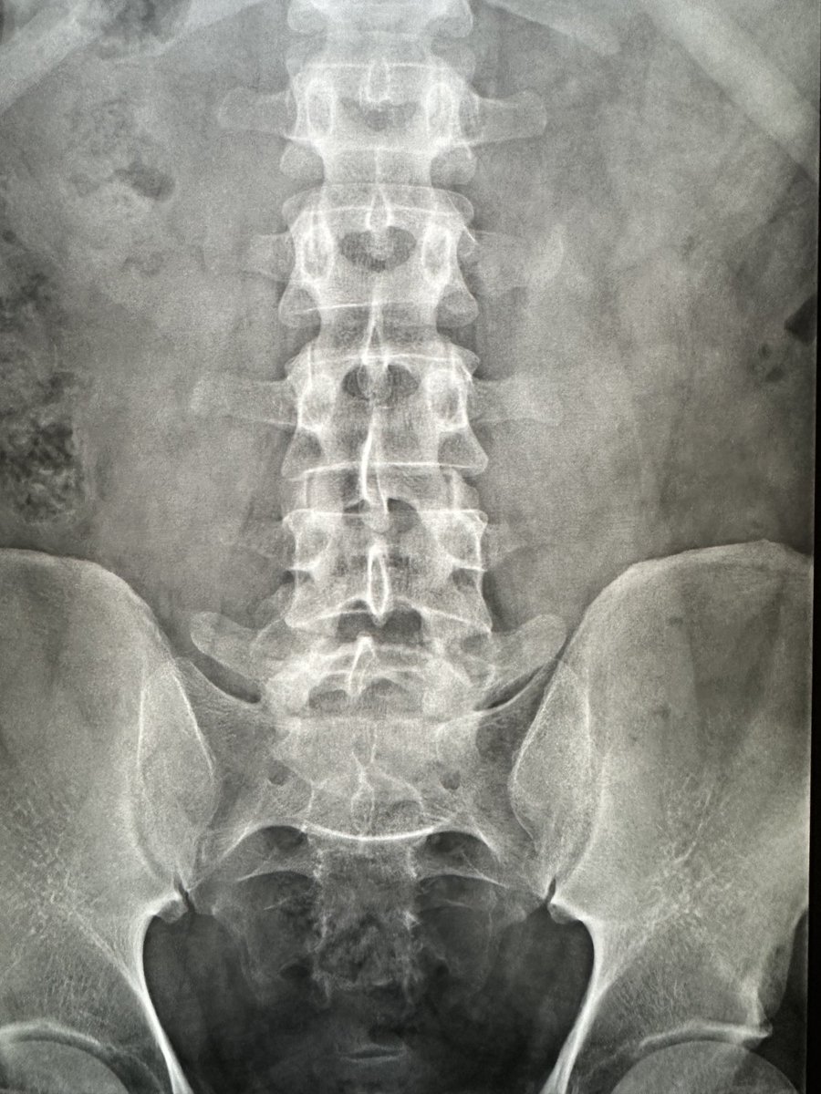 The chronic L5 spondylolysis easier to appreciate on the coned view at L5/S1. Young male.