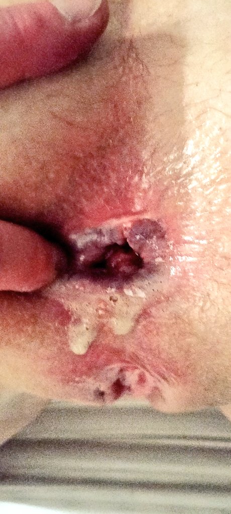 MandMunleashed's tweet photo. Result of our anal session
#anal #gaping #ruinedhole #analcouple #gape #stretchedout https://t.co/tigppDVfSD