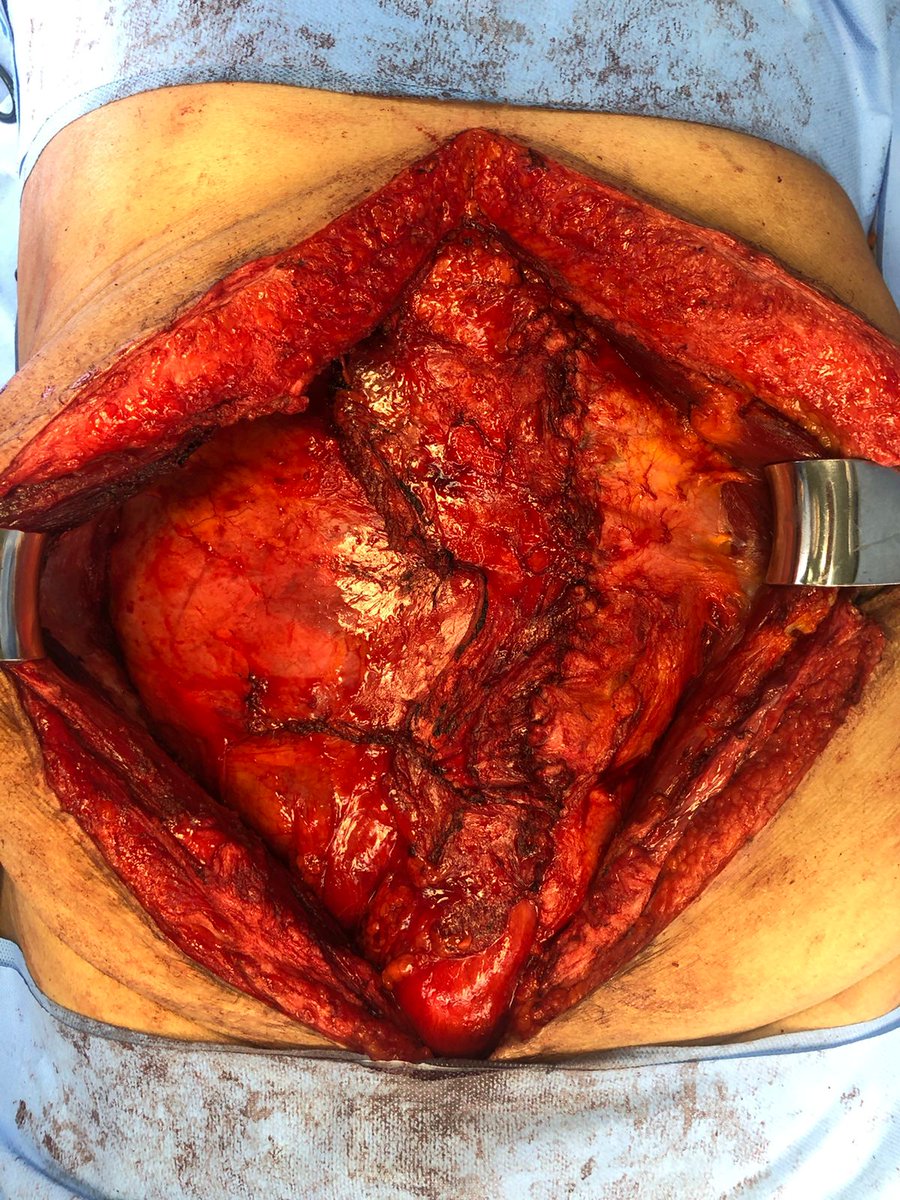 fernandowr10's tweet photo. 62y pt Hartmann colectomy in '02, reconstructed in '21 (!), with IH after 6 wks of PO. Primary repair of lateral defect and right side TAR to repair midline repair, with sublay mesh positioned (#ThisIsTheWay ).
#incisionalhernia #sublay #complexhernias #SoMe4Surgery https://t.co/pu64EAx4sI