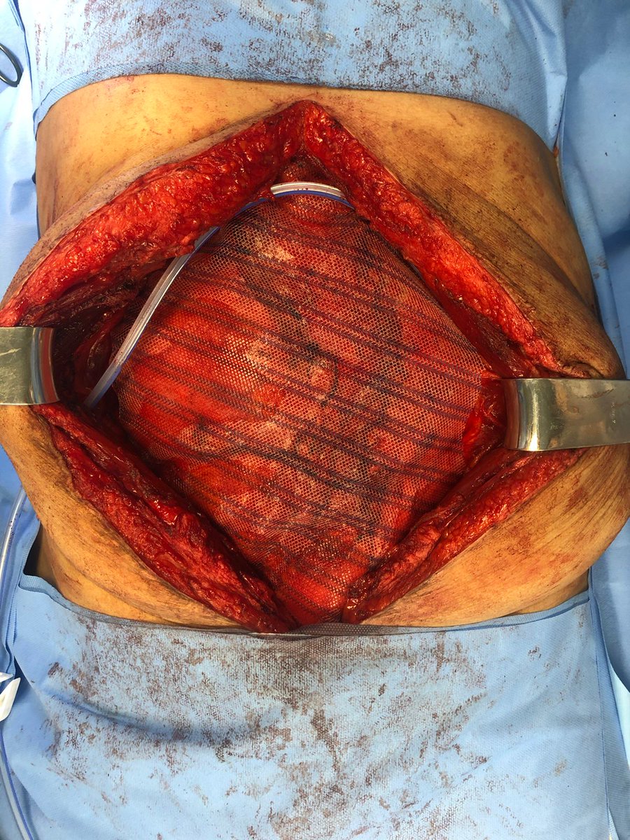 fernandowr10's tweet photo. 62y pt Hartmann colectomy in '02, reconstructed in '21 (!), with IH after 6 wks of PO. Primary repair of lateral defect and right side TAR to repair midline repair, with sublay mesh positioned (#ThisIsTheWay ).
#incisionalhernia #sublay #complexhernias #SoMe4Surgery https://t.co/pu64EAx4sI