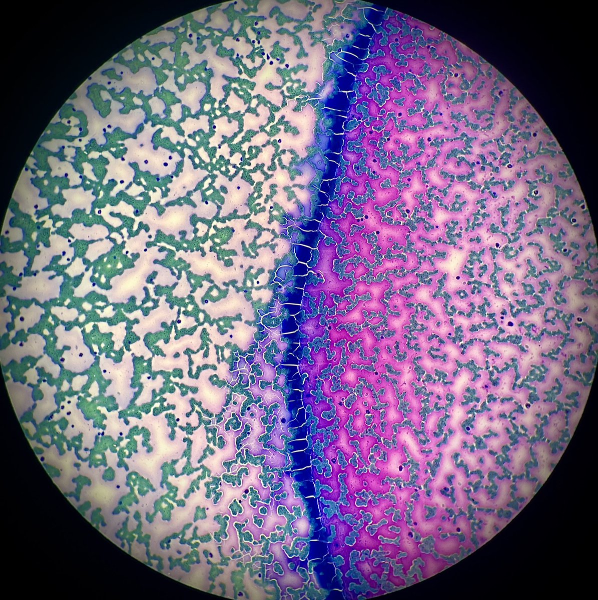 Pathology can be beautiful… even the artifact 💜 any guesses on the specimen? #cytopathology #pathtwitter @UTMB_Pathology