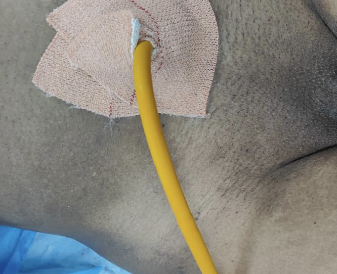 Large 7.5 cm bladder calculi completed by precutaneous method preventing open surgery