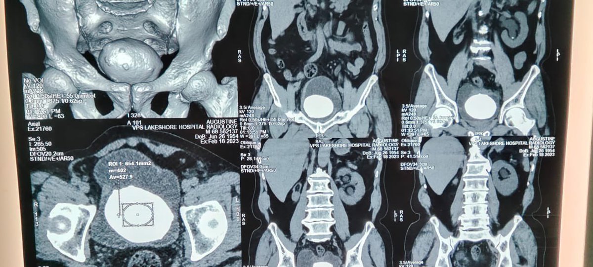 datsongeorge's tweet photo. Large 7.5 cm bladder calculi completed by precutaneous method preventing open surgery https://t.co/p7hqGxdCEA