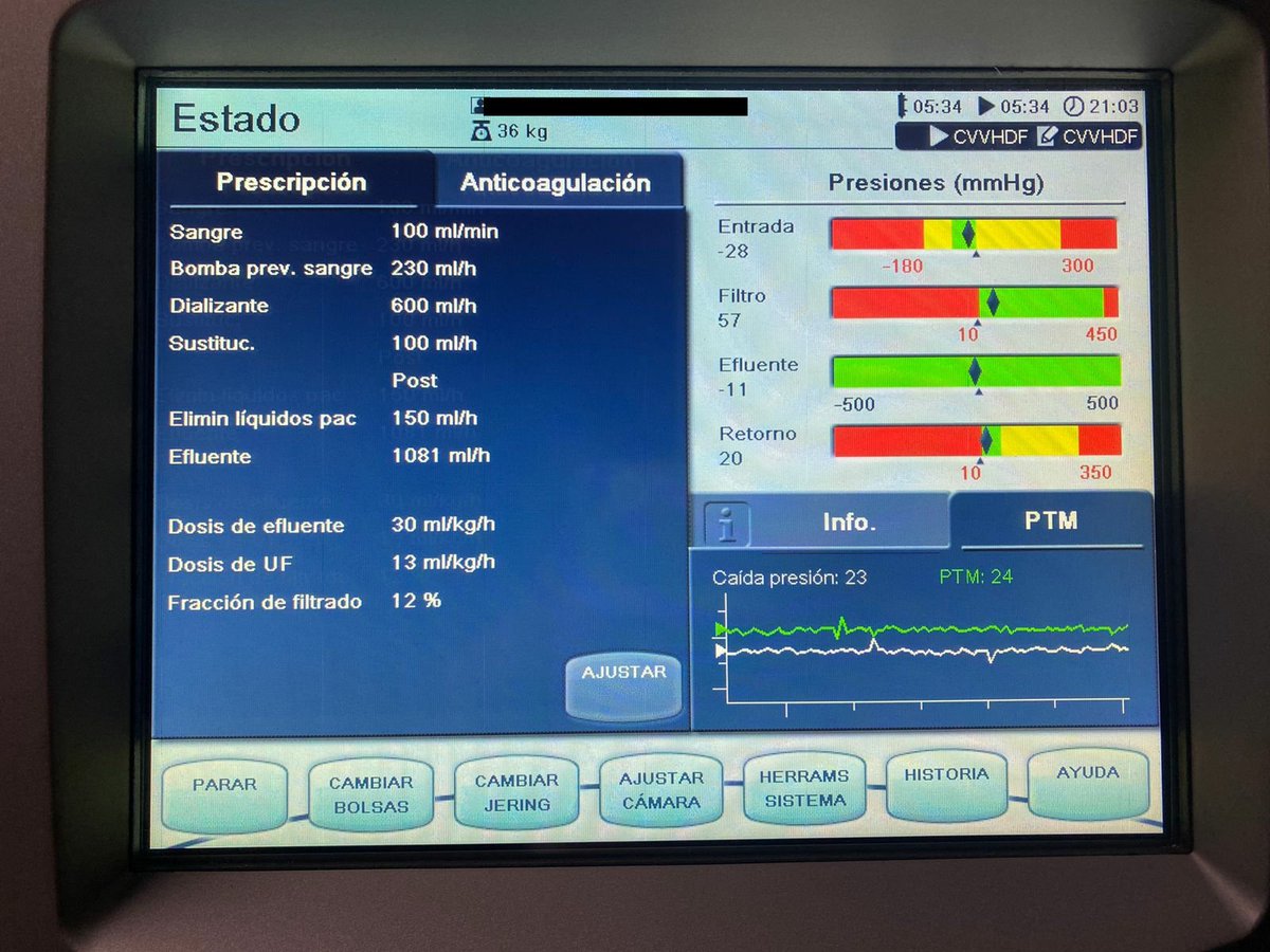 PEPJLHC's tweet photo. 50 yo ♀️ HO SLE 2 years
4 months ago 🚫MMF, HCQ, and prednisone. Admited 🏥 with dyspnea, ⬆️ SCr, Ph <7.1 HC03 10, oliguria. #POCUS pericardial and pleural effusion, #urinarysediment waxy casts and dysmorphic RBC. MP bolus Pericardiocentesis 500 ml and CRRT started #NefroGea https://t.co/lOeOnshDct