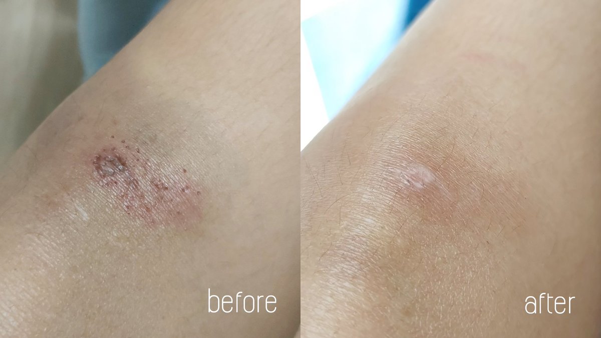 ตั้งแต่โดนรถชนวันนั้น ก็ได้แผลนี้มาแต่ดีที่ไม่เป็นอะไรมาก เราใช้เจลลดรอยแผลเป็นของ Provamed มาเดือนนึงละ เนื้อดีมากทาง่ายเป็นเหมือนฟิล์มบางๆเคลือบรอยแผล ไม่ทำให้คัน ผิวไม่ตึงเลยชุ่มชื้นมาก รอยแผลหายไวขึ้น รอยจางลงไปเยอะมากๆ นี่ใช้จนจะหมดหลอดละ มีต่อหลอดที่ 2 แน่นอน #ใช้ดีบอกต่อ