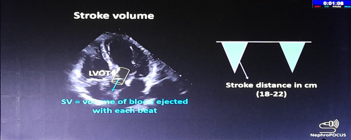 BeheraVineet's tweet photo. Dr Abhilash Koratala @KoraAbhi speaks on #POCUS #ICU at @critcareneph23 @NephroP
#VEXUS
#StrokeVolume Assessment
#criticalcarenephrologyindia #pcrrtadvances #critcareneph23
@sidsdoc @drshyambansal https://t.co/FbPDZDbPHj