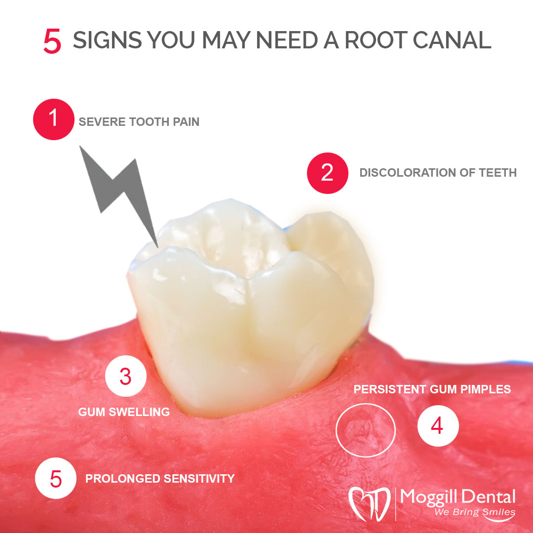 Why you may need a root canal? bit.ly/31b7Wru #smilesforlife #healthysmiles #dental #dentist #moggill #australia