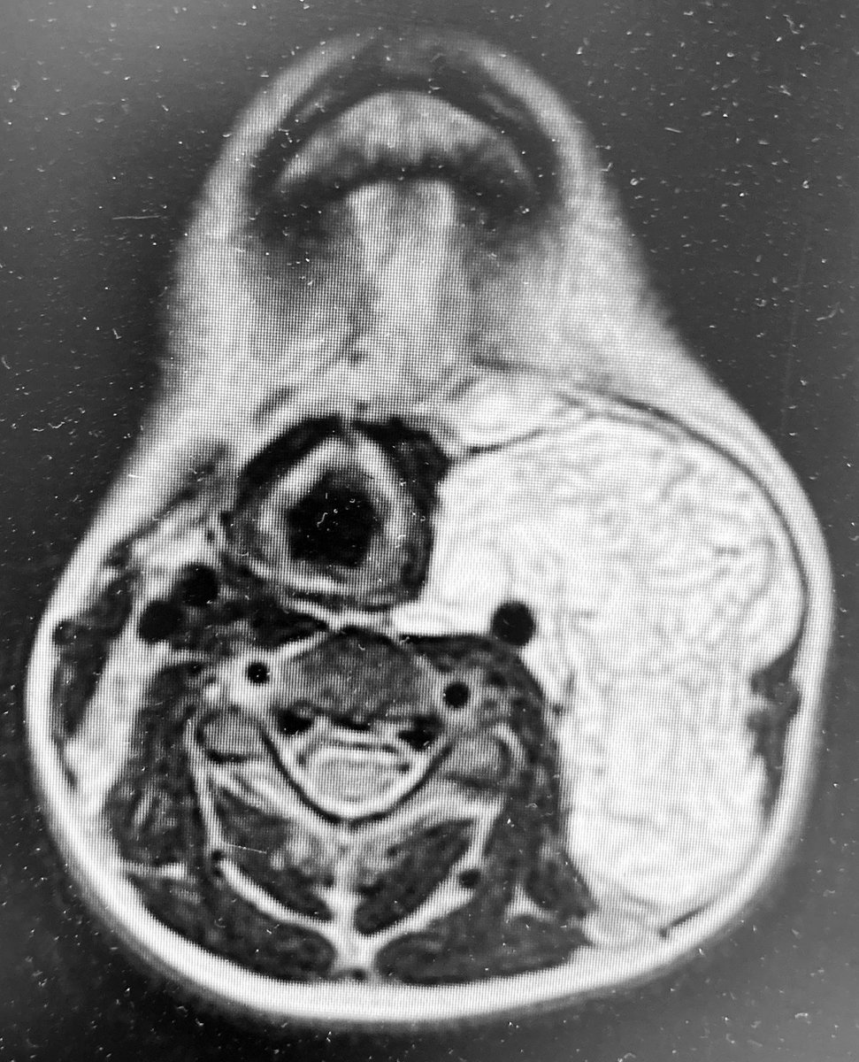 Dtepl's tweet photo. TC: a 9-year-old 👦 with history of co genital #lymphaticmalformation #sckero at days of age. Asymptomatic since then. Fever, swelling in left neck and snoring from the last 7 days.Big relapse after so many years. Steroids and antibiotics should improve clinical situation by now. https://t.co/nSsXxLO8Yn