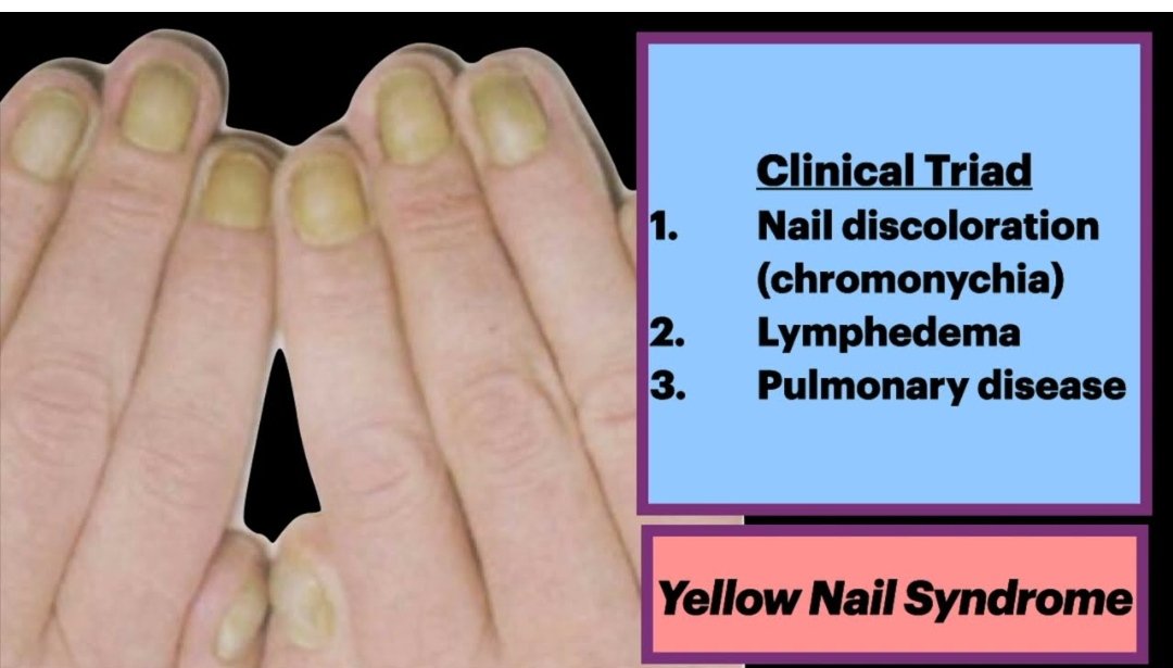 Yellow fingernails. The right index finger distal interphalangeal joint...  | Download Scientific Diagram