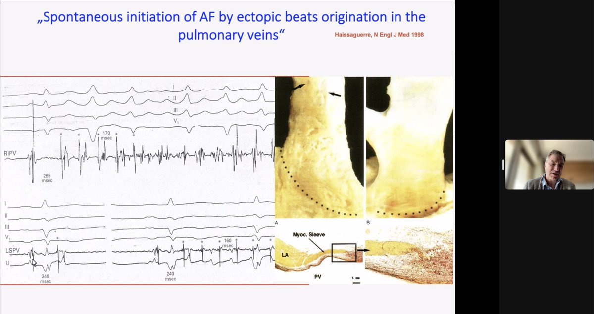 Patrick Mueller, MD (@dr_pmueller) on Twitter photo #EPFellows of #DIFP2023
Prof <a href="/LewalterT/">T Lewalter</a> started todays ´AF course´ with a fantastic talk about the cornerstone of #AF ablation - ´PV-Isolation and How to diagnose´
<a href="/BIOTRONIK_News/">BIOTRONIK News</a> <a href="/EPDeneke/">Thomas Deneke</a> <a href="/jacabreracardio/">Dr. José Ángel Cabrera</a> <a href="/Dominik_Linz/">Dominik Linz</a> <a href="/Rodrigo41353865/">Rodrigo Sá</a> <a href="/iwanari65284818/">Iwanari Kawamura</a> <a href="/vhchong1/">Vun Heng Chong</a> <a href="/omaranwar_ep/">Omar Anwar</a> #EPFellows of #DIFP2023
Prof <a href="/LewalterT/">T Lewalter</a> started todays ´AF course´ with a fantastic talk about the cornerstone of #AF ablation - ´PV-Isolation and How to diagnose´
<a href="/BIOTRONIK_News/">BIOTRONIK News</a> <a href="/EPDeneke/">Thomas Deneke</a> <a href="/jacabreracardio/">Dr. José Ángel Cabrera</a> <a href="/Dominik_Linz/">Dominik Linz</a> <a href="/Rodrigo41353865/">Rodrigo Sá</a> <a href="/iwanari65284818/">Iwanari Kawamura</a> <a href="/vhchong1/">Vun Heng Chong</a> <a href="/omaranwar_ep/">Omar Anwar</a>