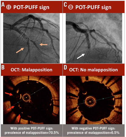 🆕"The POT-PUFF sign is a cost-free, safe and effective angiographic sign to identify stent malapposition in the POT segment, which occurs in more than 20% of cases." Read more in the article by Aminfar F et al. ow.ly/HxSP50N8U6m