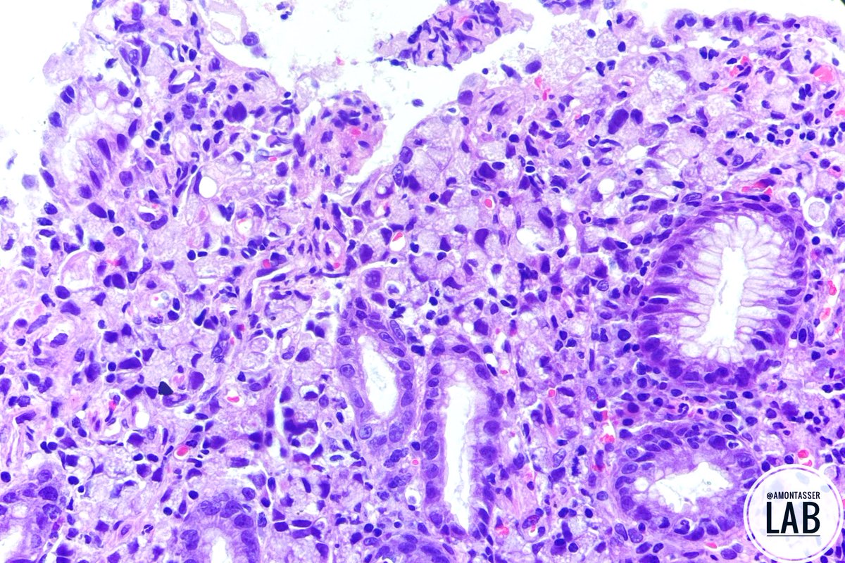 Gastric mass: poorly cohesive carcinoma - signet ring cell (PCC-SRC) 💍

#Pathology #PathTwitter #GIpath