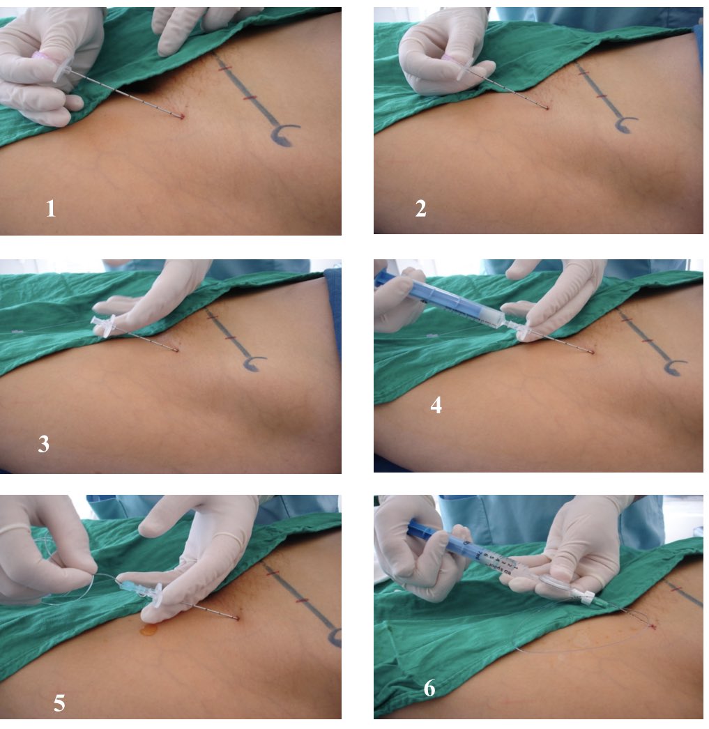 Abdu BOUAGGAD (@bouaggad_abdu) on Twitter photo Fascia iliaca block is a reproducible, safe and effective for pain management. Landmark technique still working (two pops). Single shoot or catherer #regionalanesthesia #orthopedics
<a href="/jashvant_p/">Jashvant Poeran</a> <a href="/ESchwenkMD/">Eric Schwenk, M.D., FASA</a> <a href="/dr_rajgupta/">Raj Gupta, MD, FASRA</a> <a href="/ASRA_Society/">ASRA Pain Medicine</a>
<a href="/ESRA/">esra</a> <a href="/ASRA/">Asra</a> <a href="/AFSRA/">Afsra</a> <a href="/RegionalAnaesUK/">RA-UK</a> Fascia iliaca block is a reproducible, safe and effective for pain management. Landmark technique still working (two pops). Single shoot or catherer #regionalanesthesia #orthopedics
<a href="/jashvant_p/">Jashvant Poeran</a> <a href="/ESchwenkMD/">Eric Schwenk, M.D., FASA</a> <a href="/dr_rajgupta/">Raj Gupta, MD, FASRA</a> <a href="/ASRA_Society/">ASRA Pain Medicine</a>
<a href="/ESRA/">esra</a> <a href="/ASRA/">Asra</a> <a href="/AFSRA/">Afsra</a> <a href="/RegionalAnaesUK/">RA-UK</a>