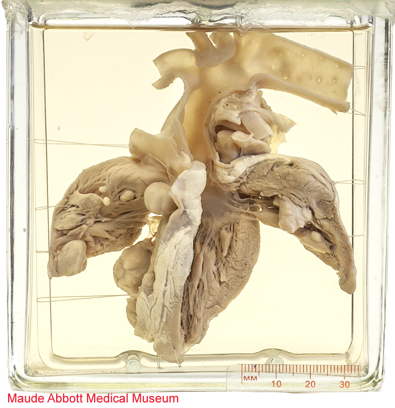 Jonathan Lai (@jonlaimd) on Twitter photo What's the diagnosis and most common syndrome associated with this finding?
Heart specimen from <a href="/McGill_MAMM/">McGill MAMM</a>, collected in 1932.
More details are in the comments below.
#GrossDiagnosis #CardioPath #Autopsy #McGill24 #PathTwitter #PathBoards What's the diagnosis and most common syndrome associated with this finding?
Heart specimen from <a href="/McGill_MAMM/">McGill MAMM</a>, collected in 1932.
More details are in the comments below.
#GrossDiagnosis #CardioPath #Autopsy #McGill24 #PathTwitter #PathBoards