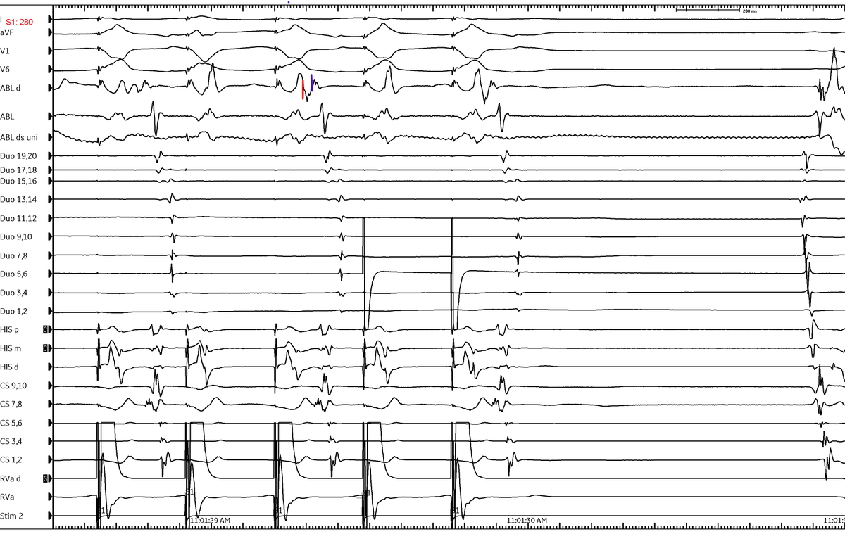 Importance of rapid pacing to achieve 2:1 block during retro mapping of concealed PS AP. Looking at last 2 beats difficult to be sure where retro A starts, but with isolated V clear that it starts at red line (early) not blue (late c/w CS 7,8). Not new but worth reminder IMHO.