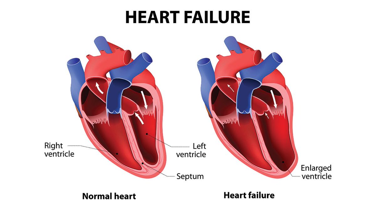 heart-failure-types-definition-symptoms