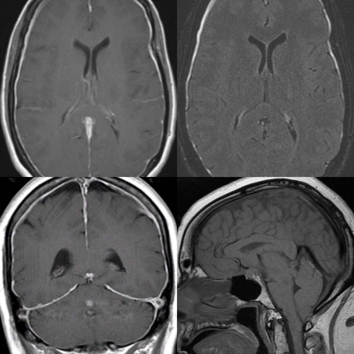 daniel_gewolb's tweet photo. Imaging findings of Intracranial HYPOtension in multiple patients

Etiology: CSF cushions the brain and spine, therefore, anything that reduces the volume of CSF can lead to intracranial HYPOtension

Imaging and learning points in thread #Neurology #neurotwitter @TheASNR #radres https://t.co/n0s2tXX8Rg