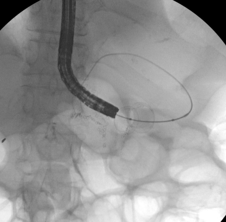 David Diehl (@daviddiehlmd) on Twitter photo Years ago, <a href="/mikewallacemd/">Michael Wallace</a> told me that there was no such thing as an emergency EUS. I guess things have changed! This RYGB patient had GOO and needed decompression. How often have you had to do an EUS as an emergency? <a href="/DouglasAdlerMD/">Douglas G. Adler MD, FASGE, FACG, AGAF</a> <a href="/neilRsharmaMD/">Neil Sharma, M.D. FASGE, FACG, AGAF</a> <a href="/NeilBhogalMD/">Neil Bhogal, MD</a> Years ago, <a href="/mikewallacemd/">Michael Wallace</a> told me that there was no such thing as an emergency EUS. I guess things have changed! This RYGB patient had GOO and needed decompression. How often have you had to do an EUS as an emergency? <a href="/DouglasAdlerMD/">Douglas G. Adler MD, FASGE, FACG, AGAF</a> <a href="/neilRsharmaMD/">Neil Sharma, M.D. FASGE, FACG, AGAF</a> <a href="/NeilBhogalMD/">Neil Bhogal, MD</a>
