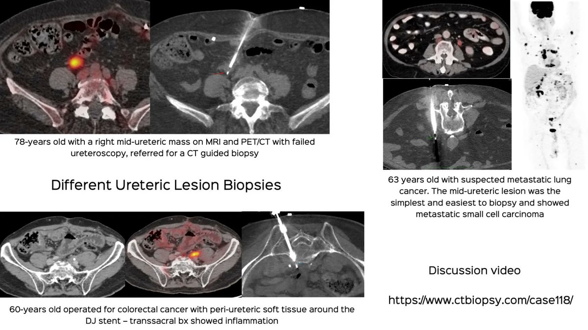 Different Ureteric Lesion Biopsies

Three different cases of mid-ureteric lesion biopsies

Discussion and video 
ctbiopsy.com/case118/

#ctbiopsy #irrad #ureter #uretericbiopsy #urothelialcarcinoma