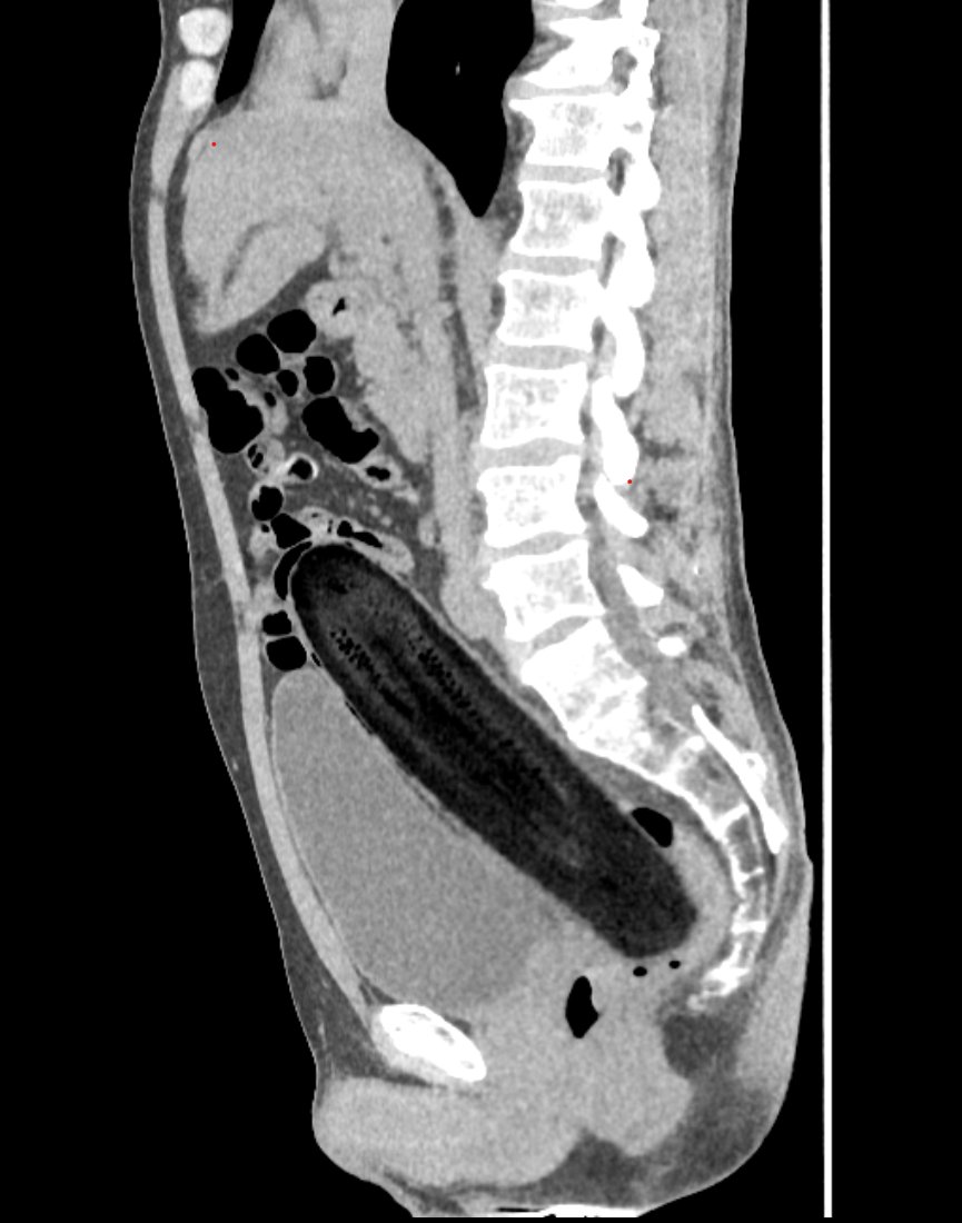 medslicer's tweet photo. Intrarectal zucchini 3D reconstruction
#vegetable #surgery #proctology #3DCG https://t.co/SFm5P91TYg