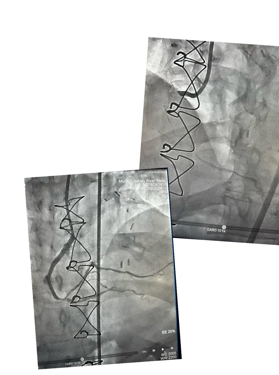 #ACC2023 , here are the pre & post!! Recross Antegrade to get into distal RCA & RCART With Astado. Thanks @KateKearney4 for all the help. Thanks to the panelists @DrDarshanDoshi @RhianEDavies1 @mirvatalasnag @schuyler_jones and my great team 🙏🏼🙏🏼@MUSCCardFellows